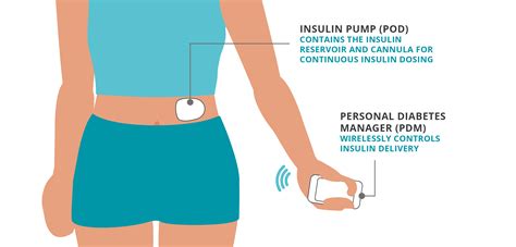 tubeless insulin pump under skin